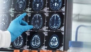 ¿Luz al final del túnel con la demencia?