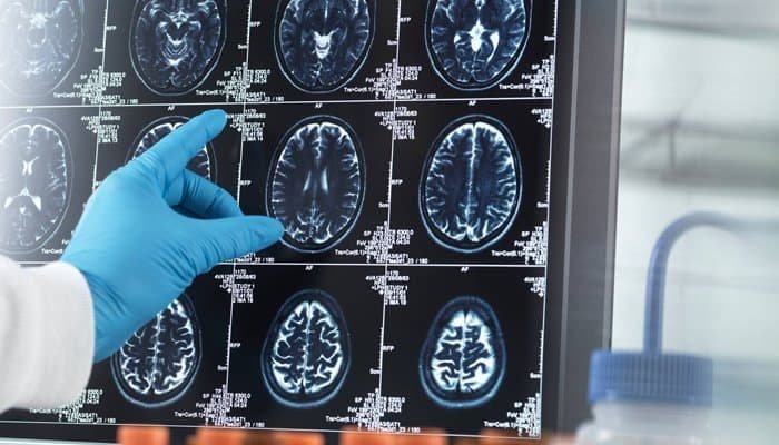 ¿Luz al final del túnel con la demencia?