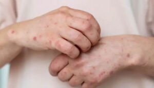 Colombia y sus medidas ante el sarampión