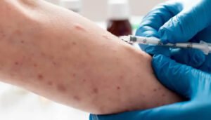 Más casos importados de sarampión en Colombia