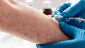 Alerta sanitaria en Colombia por casos de sarampión