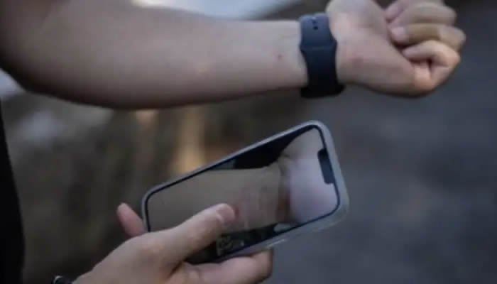 Nueva variedad de la viruela símica en Colombia